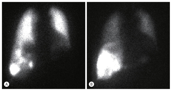 Advanced Stage Hepatocellular Carcinoma Successfully Treated with Liver-directed Concurrent Chemoradiotherapy and Sequential Transarterial Radio-embolization.