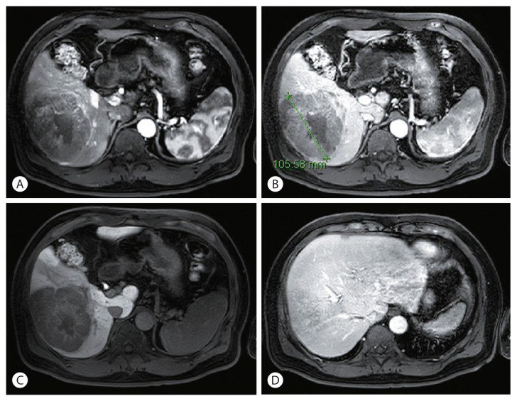 Advanced Stage Hepatocellular Carcinoma Successfully Treated with Liver-directed Concurrent Chemoradiotherapy and Sequential Transarterial Radio-embolization.