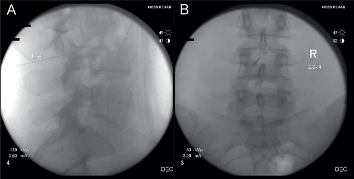 Effectiveness of Intrathecal Baclofen for Intractable Stiffperson Syndrome: a Case Report.