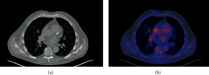 Atypical Nodular Pulmonary Kappa Light-Chain Deposition.