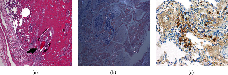 Atypical Nodular Pulmonary Kappa Light-Chain Deposition.