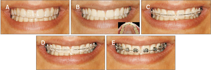 Reasons influencing the preferences of prospective patients and orthodontists for different orthodontic appliances.