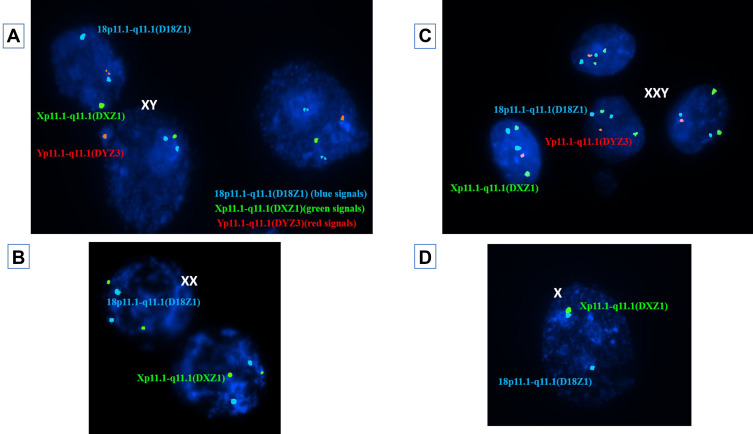 The Effect of Teratozoospermia on Sex Chromosomes in Human Embryos.