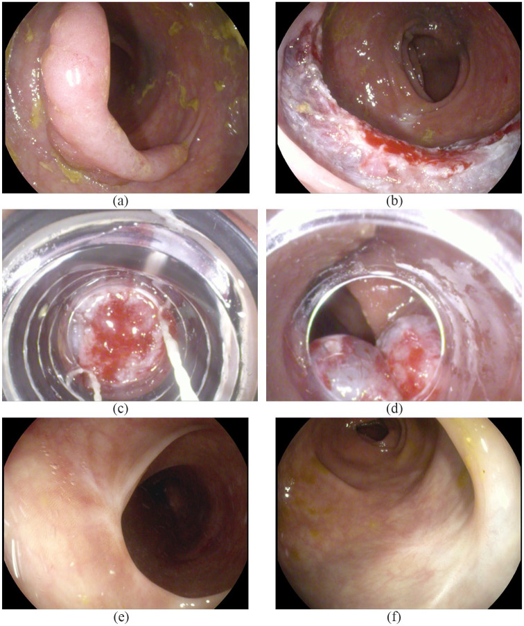 Safety and efficacy of band ligation and auto-amputation as adjunct to EMR of colonic large laterally spreading tumors, and polyps not amenable to routine polypectomy.