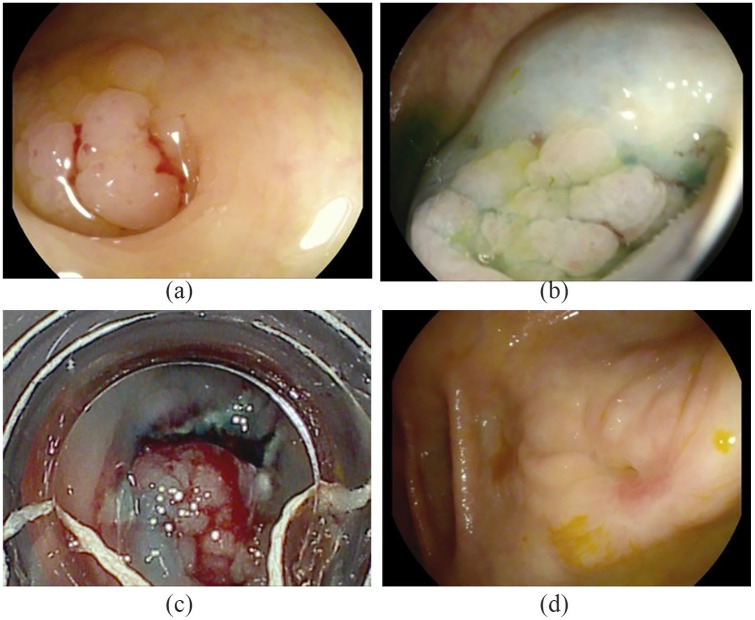 Safety and efficacy of band ligation and auto-amputation as adjunct to EMR of colonic large laterally spreading tumors, and polyps not amenable to routine polypectomy.