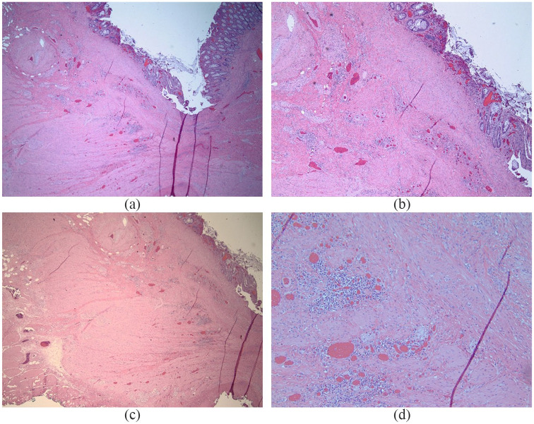 Safety and efficacy of band ligation and auto-amputation as adjunct to EMR of colonic large laterally spreading tumors, and polyps not amenable to routine polypectomy.