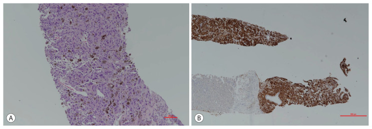 A Case of Metastatic Melanoma in the Liver Mimicking Hepatocellular Carcinoma.