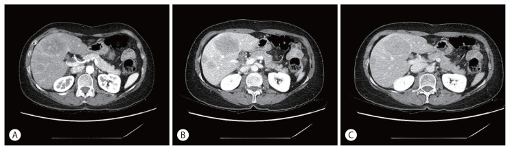 A Case of Metastatic Melanoma in the Liver Mimicking Hepatocellular Carcinoma.