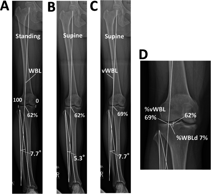 Differences in preoperative planning for high-tibial osteotomy between the standing and supine positions.