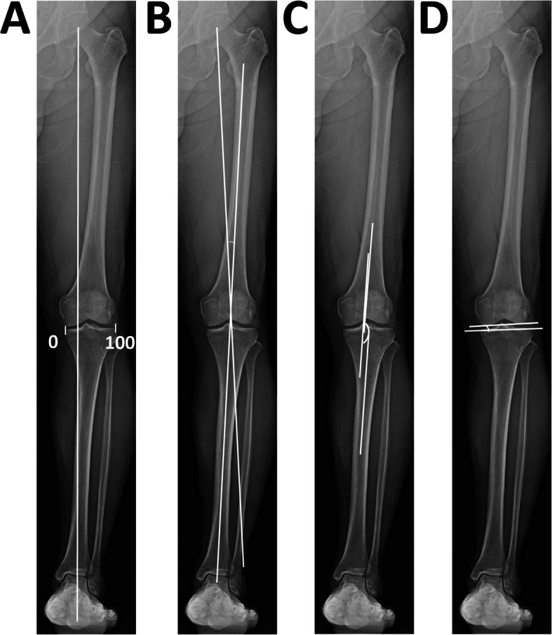 Differences in preoperative planning for high-tibial osteotomy between the standing and supine positions.