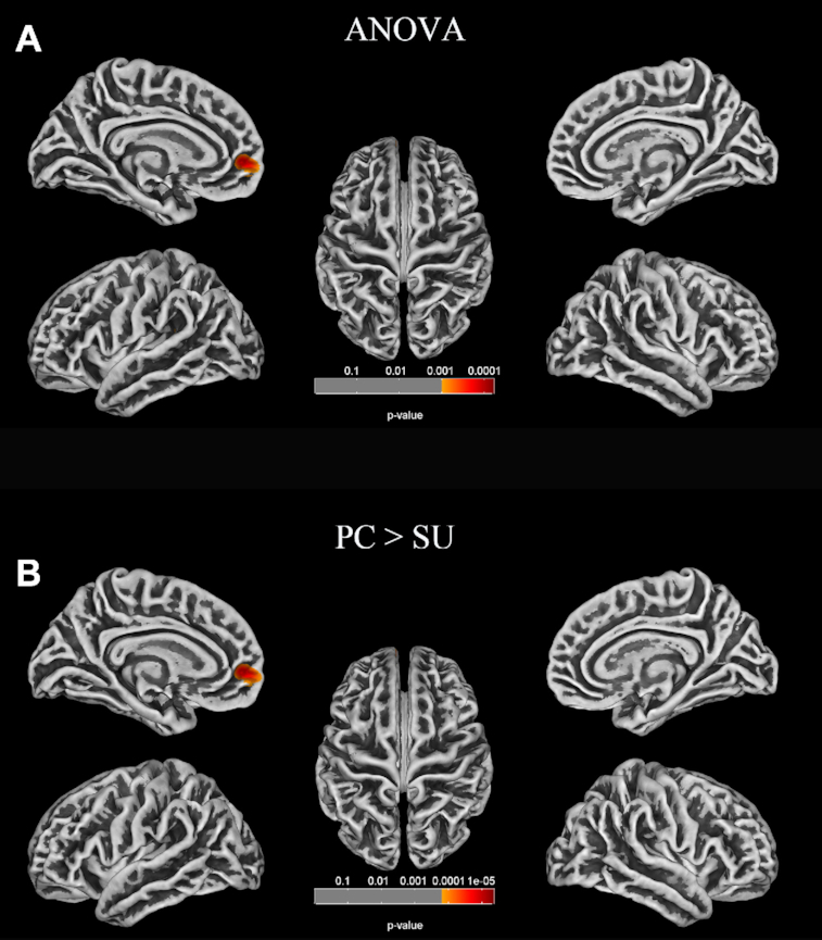 Altered cortical morphology in major depression disorder patients with suicidality.
