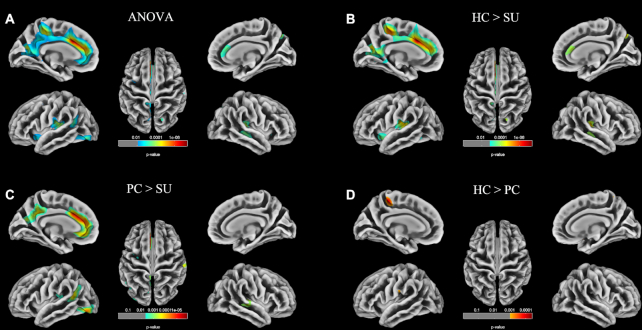 Altered cortical morphology in major depression disorder patients with suicidality.