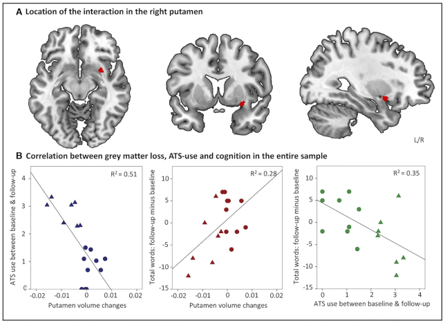 A prospective longitudinal study shows putamen volume is associated with moderate amphetamine use and resultant cognitive impairments.