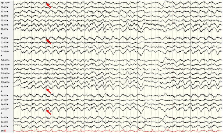 Symptomatologic pathomechanism of <i>N</i>-methyl D-aspartate receptor encephalitis.
