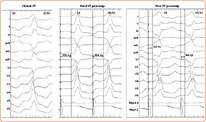 Dynamic High-density Functional Substrate Mapping Improves Outcomes in Ischaemic Ventricular Tachycardia Ablation: Sense Protocol Functional Substrate Mapping and Other Functional Mapping Techniques.