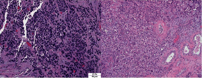 Complaint of Testicular Discomfort in Patient with Esophageal Adenocarcinoma.