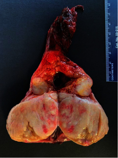 Complaint of Testicular Discomfort in Patient with Esophageal Adenocarcinoma.