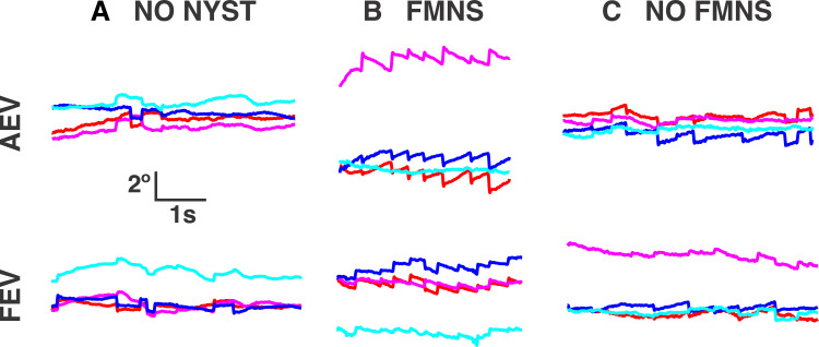 Monocular and Binocular Visual Function Deficits in Amblyopic Patients with and without Fusion Maldevelopment Nystagmus.