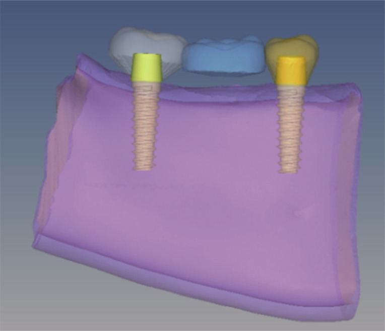 Comparative evaluation of peri-implant stress distribution in implant protected occlusion and cuspally loaded occlusion on a 3 unit implant supported fixed partial denture: A 3D finite element analysis study.