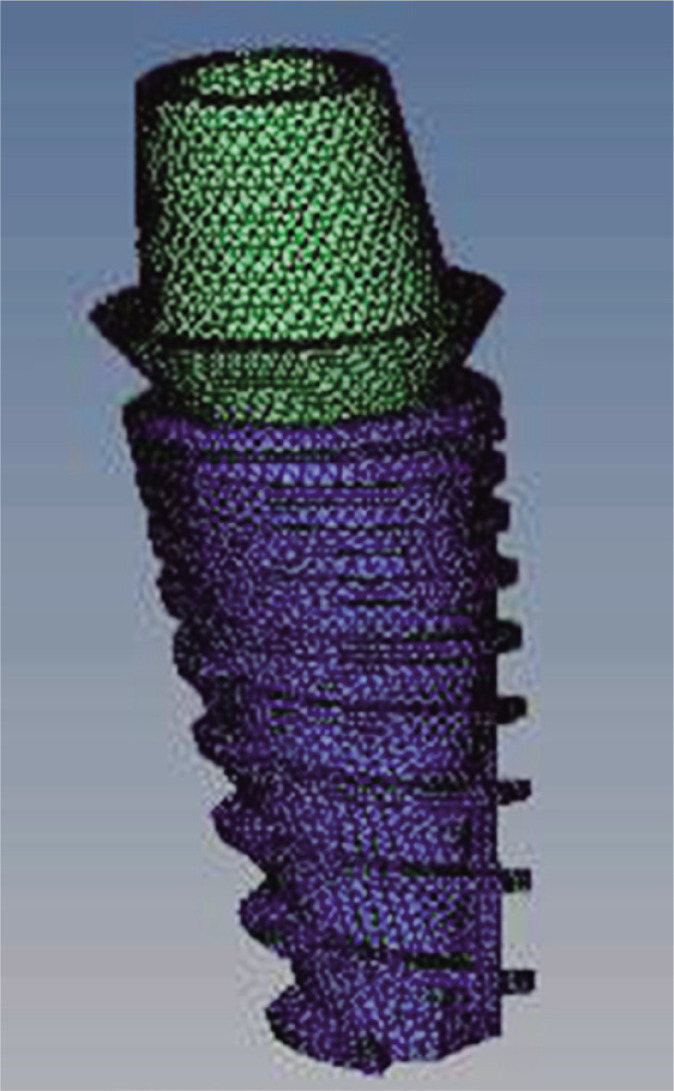 Comparative evaluation of peri-implant stress distribution in implant protected occlusion and cuspally loaded occlusion on a 3 unit implant supported fixed partial denture: A 3D finite element analysis study.