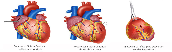 Damage control in penetrating cardiac trauma.