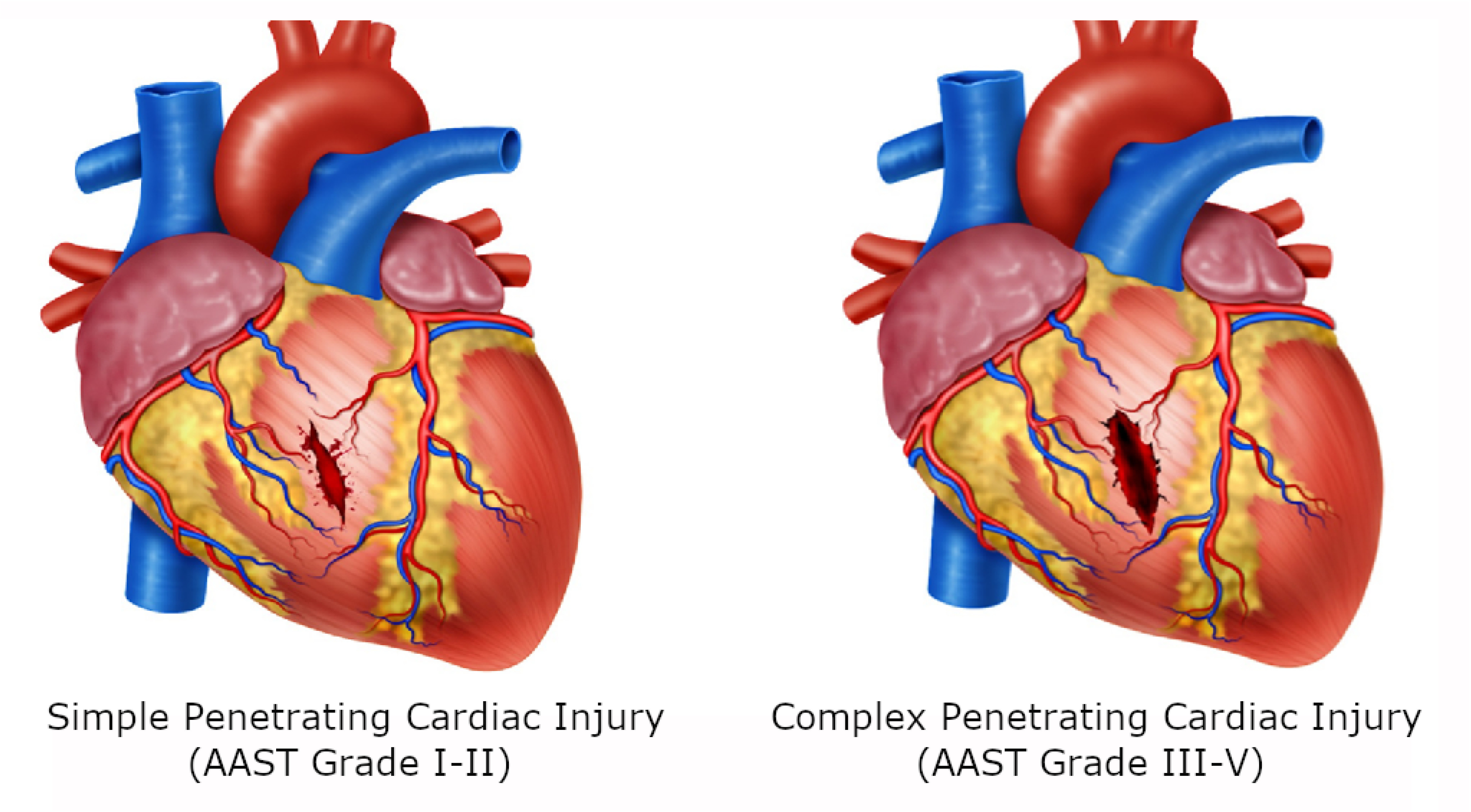 Damage control in penetrating cardiac trauma.