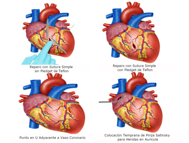 Damage control in penetrating cardiac trauma.