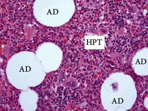 Rare Case of Multiple Perirenal, Extra-Adrenal Myelolipoma: Case Report, Current Management Options, and Literature Review.