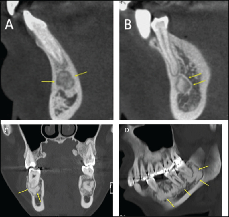 Sclerotic Lesions of the Jaw: A Pictorial Review.