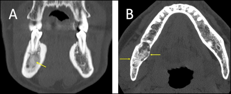 Sclerotic Lesions of the Jaw: A Pictorial Review.