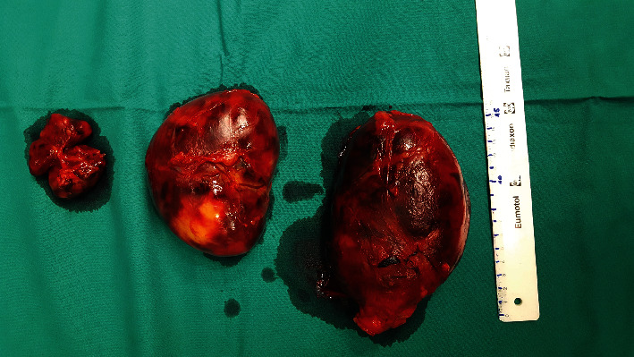 Rare Case of Multiple Perirenal, Extra-Adrenal Myelolipoma: Case Report, Current Management Options, and Literature Review.