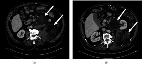 Rare Case of Multiple Perirenal, Extra-Adrenal Myelolipoma: Case Report, Current Management Options, and Literature Review.