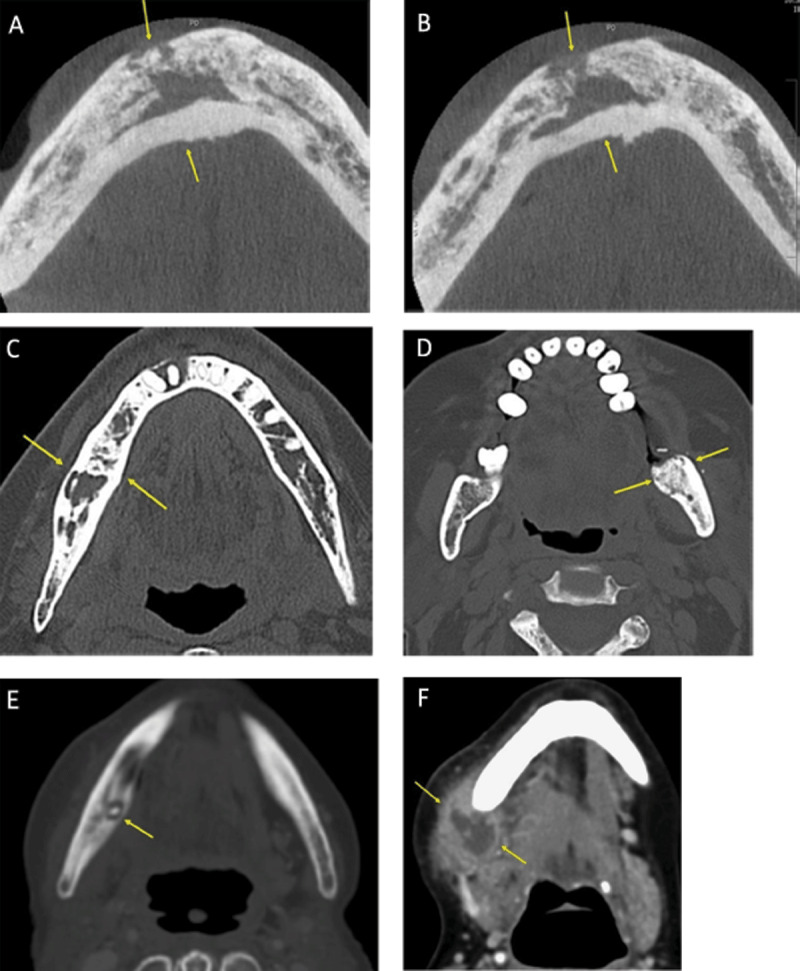 Sclerotic Lesions of the Jaw: A Pictorial Review.