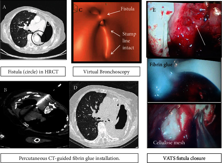 Combining Minimally Invasive Techniques in Managing a Frail Patient with Postpneumonectomy Bronchopleural Fistula.