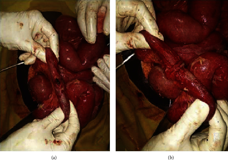 Acute Generalized Peritonitis in a Peripheral Hospital Centre in Benin: Can It Be Managed by a Local General Practitioner?