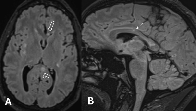 Snowballs and Icicles in Susac's Syndrome.