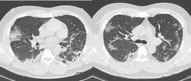 Chest CT Diagnosis of COVID-19: Accuracy using CO-RADS and CT-Involvement Scoring.