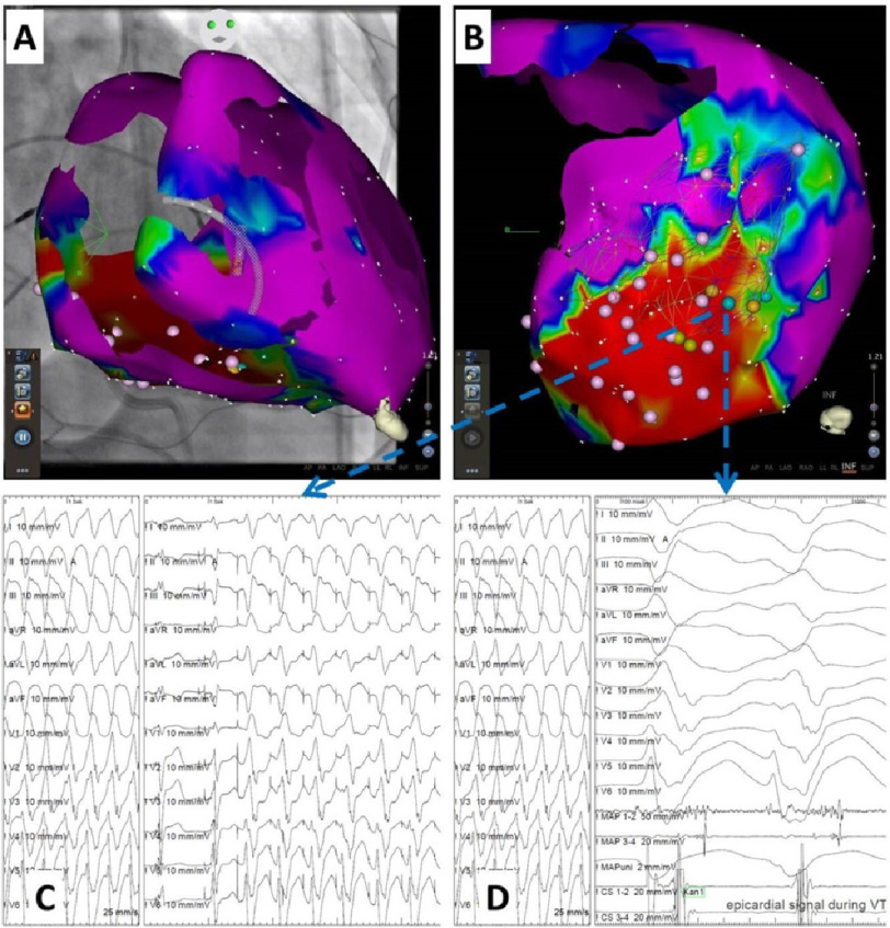 Epicardial mapping and ablation for ventricular arrhythmias in experienced center without onsite cardiac surgery.