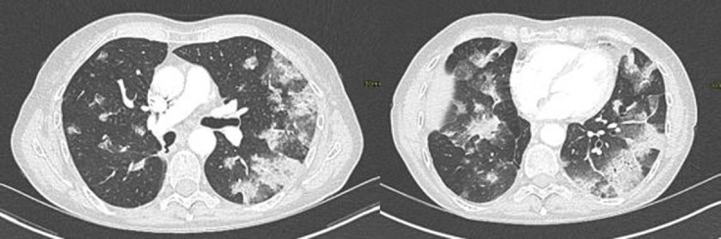 Chest CT Diagnosis of COVID-19: Accuracy using CO-RADS and CT-Involvement Scoring.