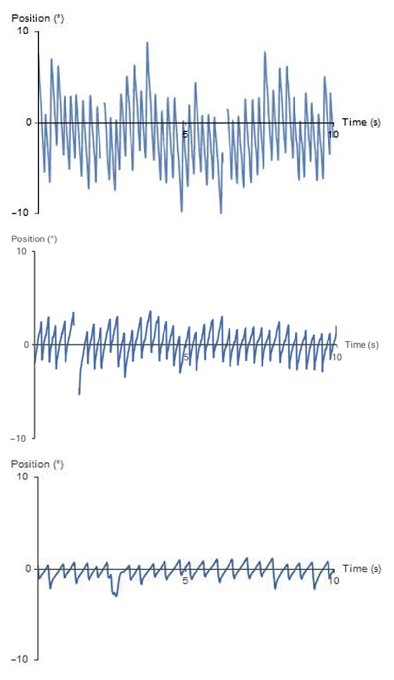 The Use of Botulinum Toxin in a Case of Acquired Periodic Alternating Nystagmus.