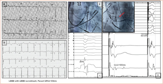 Conduction System Pacing for Cardiac Resynchronisation.