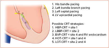 Conduction System Pacing for Cardiac Resynchronisation.