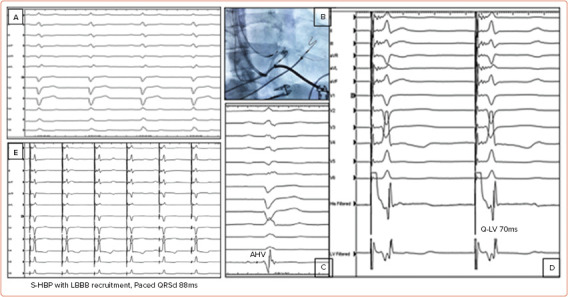 Conduction System Pacing for Cardiac Resynchronisation.