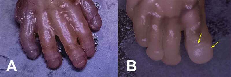 A Comprehensive Study Regarding the Intrauterine Development of Nails.