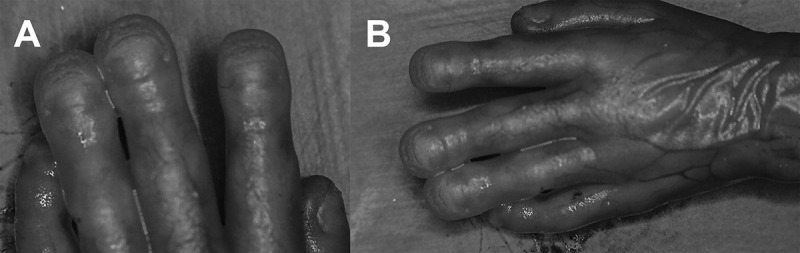 A Comprehensive Study Regarding the Intrauterine Development of Nails.