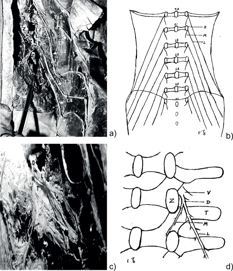 Spinal Dorsal Rami Injection and Radiofrequency Neurolysis for Low Back Pain Caused by Osteoporosis-Induced Thoracolumbar Vertebral Compression Fractures.