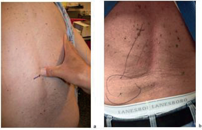 Spinal Dorsal Rami Injection and Radiofrequency Neurolysis for Low Back Pain Caused by Osteoporosis-Induced Thoracolumbar Vertebral Compression Fractures.