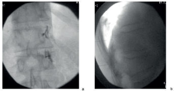 Spinal Dorsal Rami Injection and Radiofrequency Neurolysis for Low Back Pain Caused by Osteoporosis-Induced Thoracolumbar Vertebral Compression Fractures.