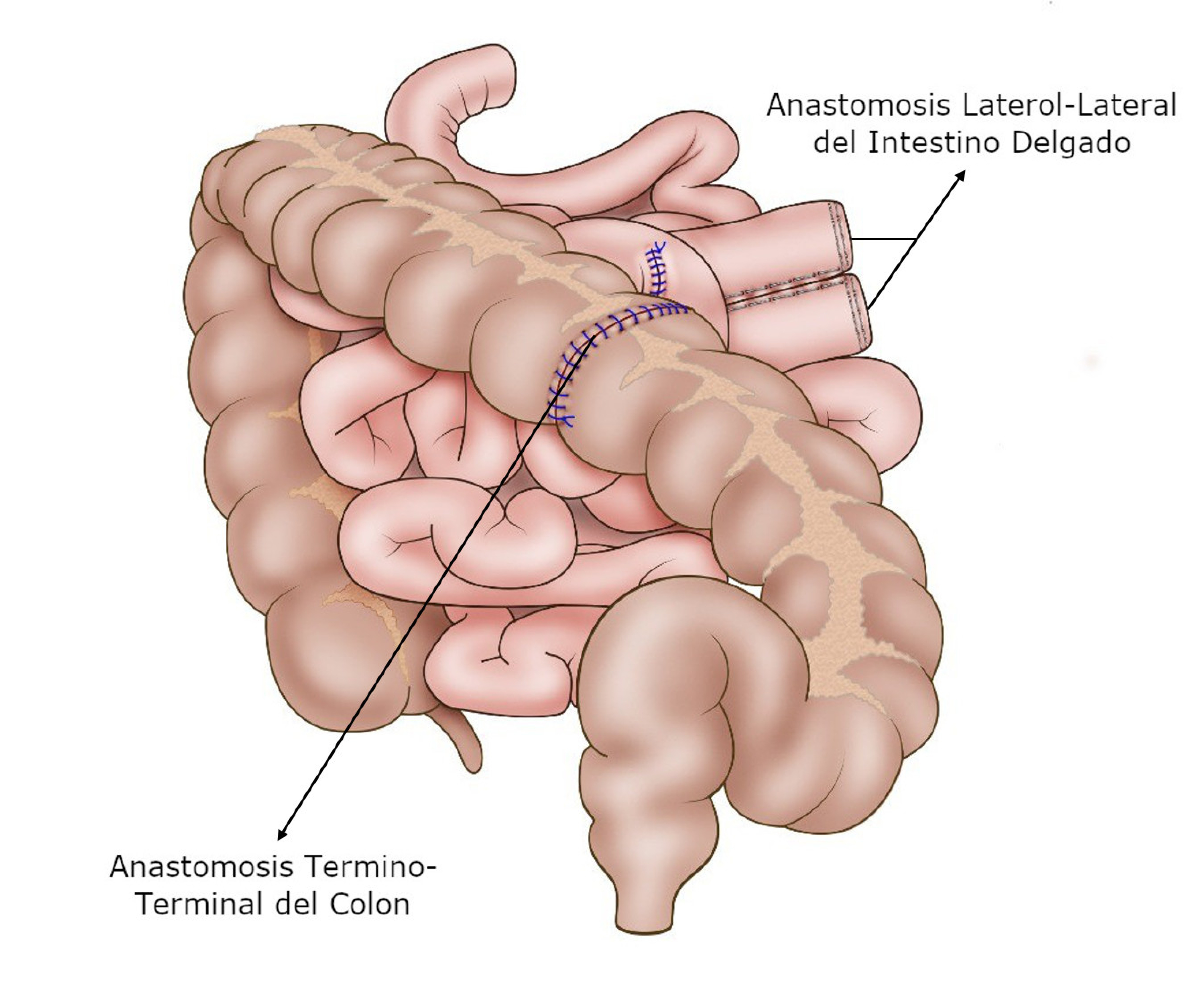 Damage control surgical management of combined small and large bowel injuries in penetrating trauma: Are ostomies still pertinent?