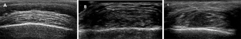 Subgaleal Lipoma: Imaging Findings.